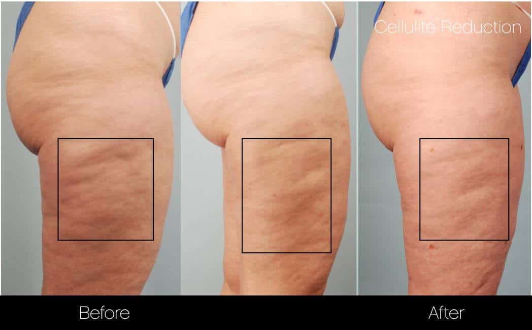 Cellulite reduction treatments in spas