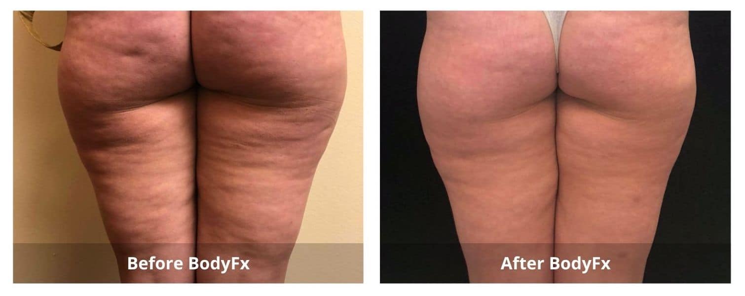 Body Fx Cellulite Treatment – UCosmetic