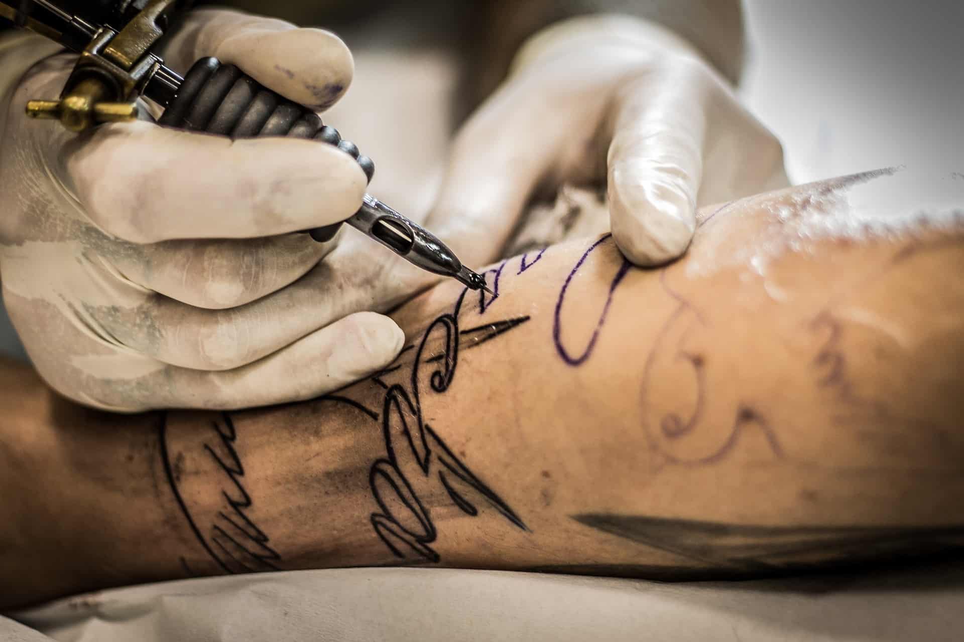 Tattoo Removal treatment