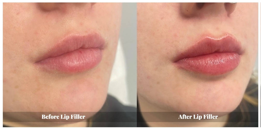 lip fillers before and after kitchener waterloo cambridge