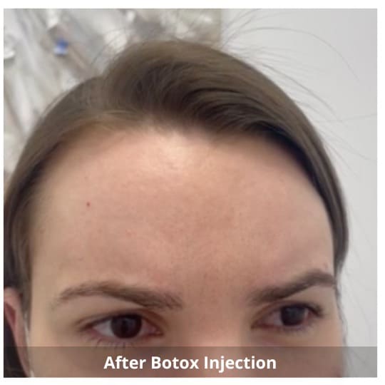 Botox Injections Waterloo & Kitchener