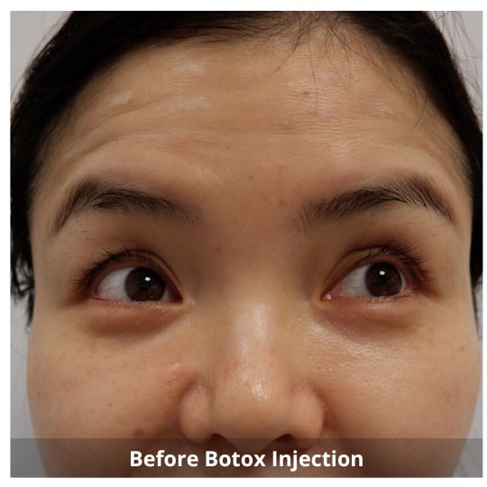 Botox Injections Waterloo & Kitchener
