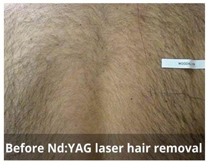 Laser Hair Removal Waterloo & Kitchener