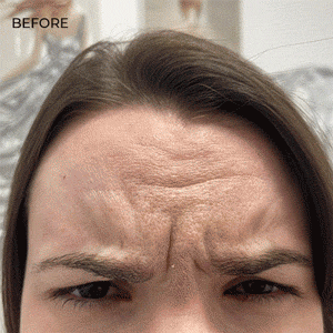 Botox for Forehead & Frown Lines