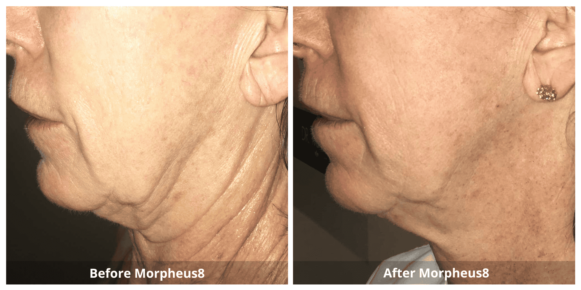 Morpheus8 Neck Treatment Before and After photo