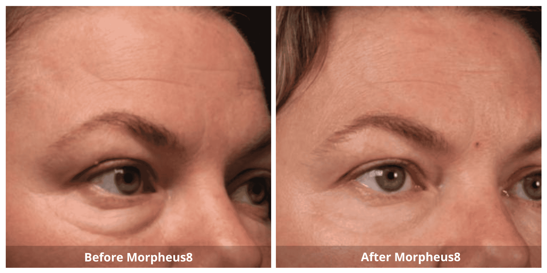 Morpheus8 Under Eyes Treatment Before and After photo