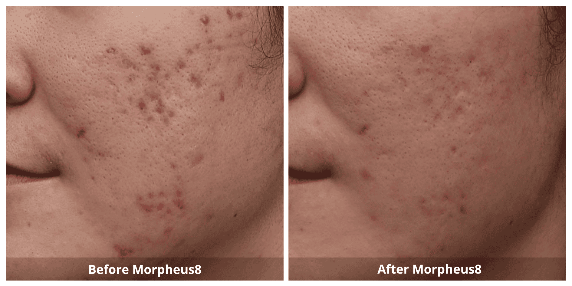 Morpheus8 Acne Scars Treatment Before and After photo
