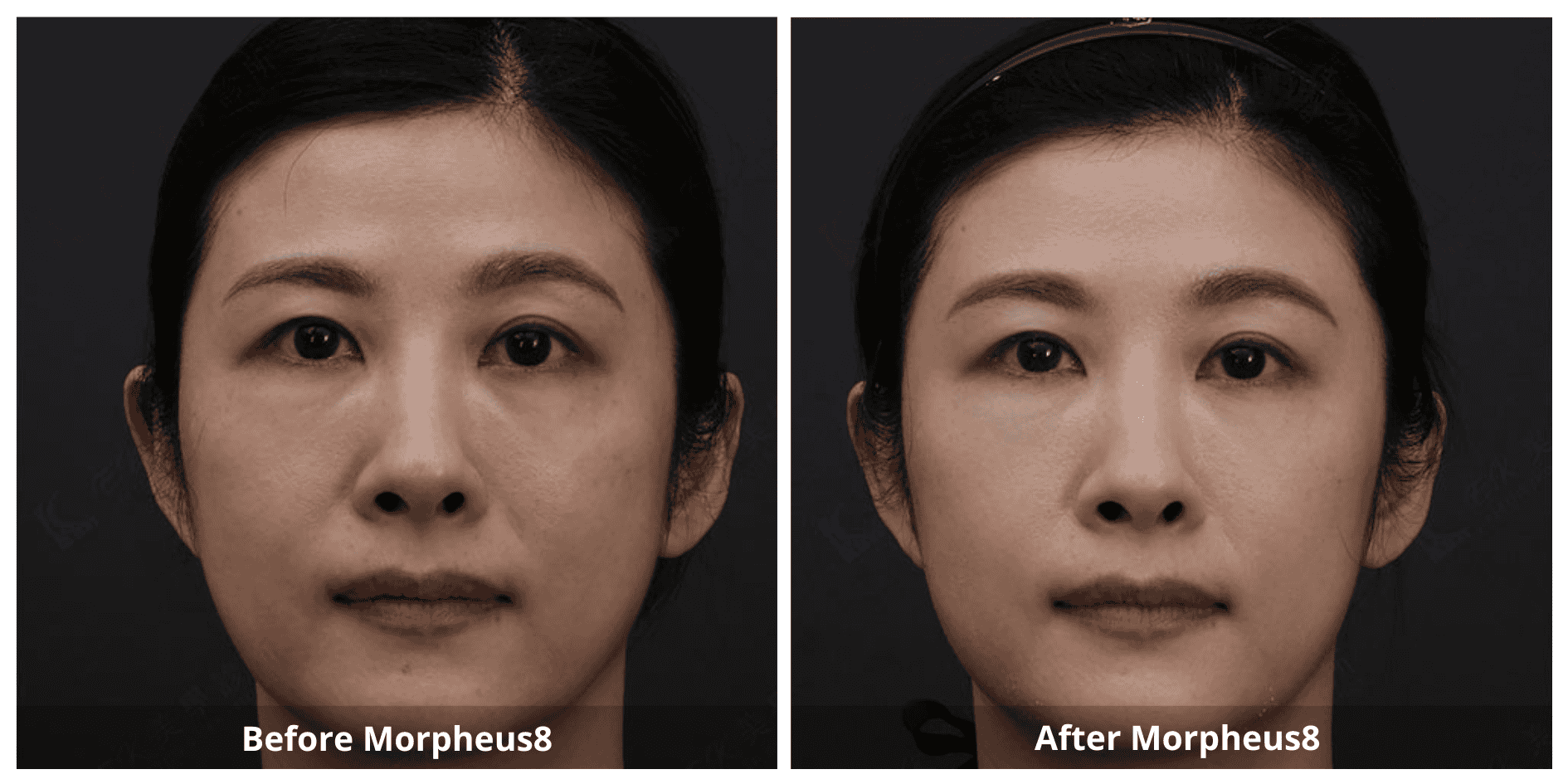 Morpheus8 Skin Resurfacing Treatment Before and After photo