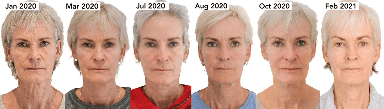 Judy Murray Morpheus8 before and after pics