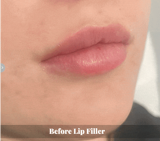 Before & After Lip Filler Campaign
