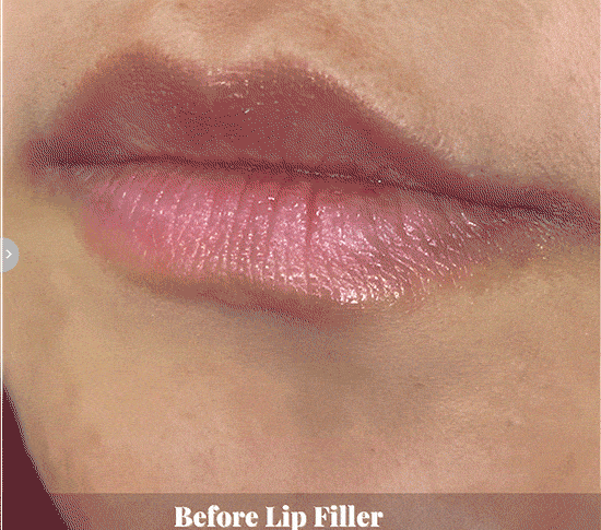Lip Filler Campaign Before & AFter 3