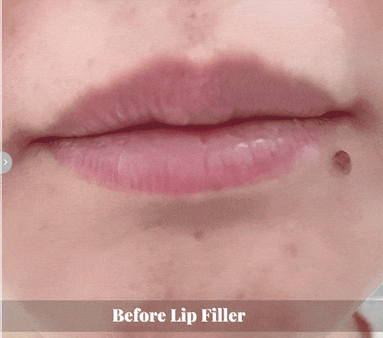 Lip Filler Campaign Before & AFter 4