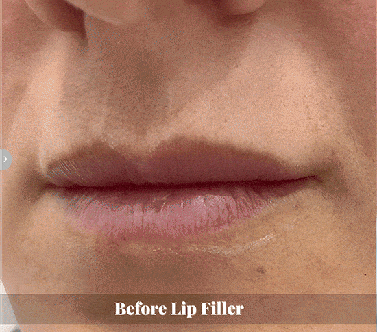 Lip Filler Campaign Before & AFter 5