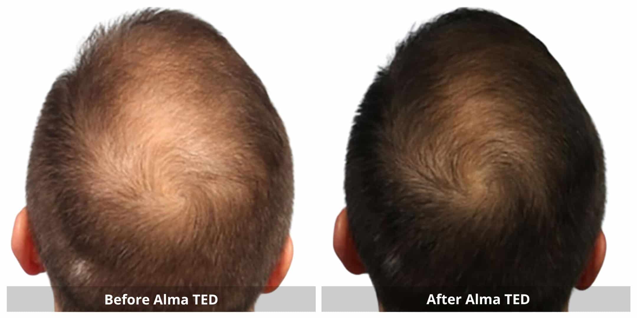 Alma ted hair restoration before and after photo 1
