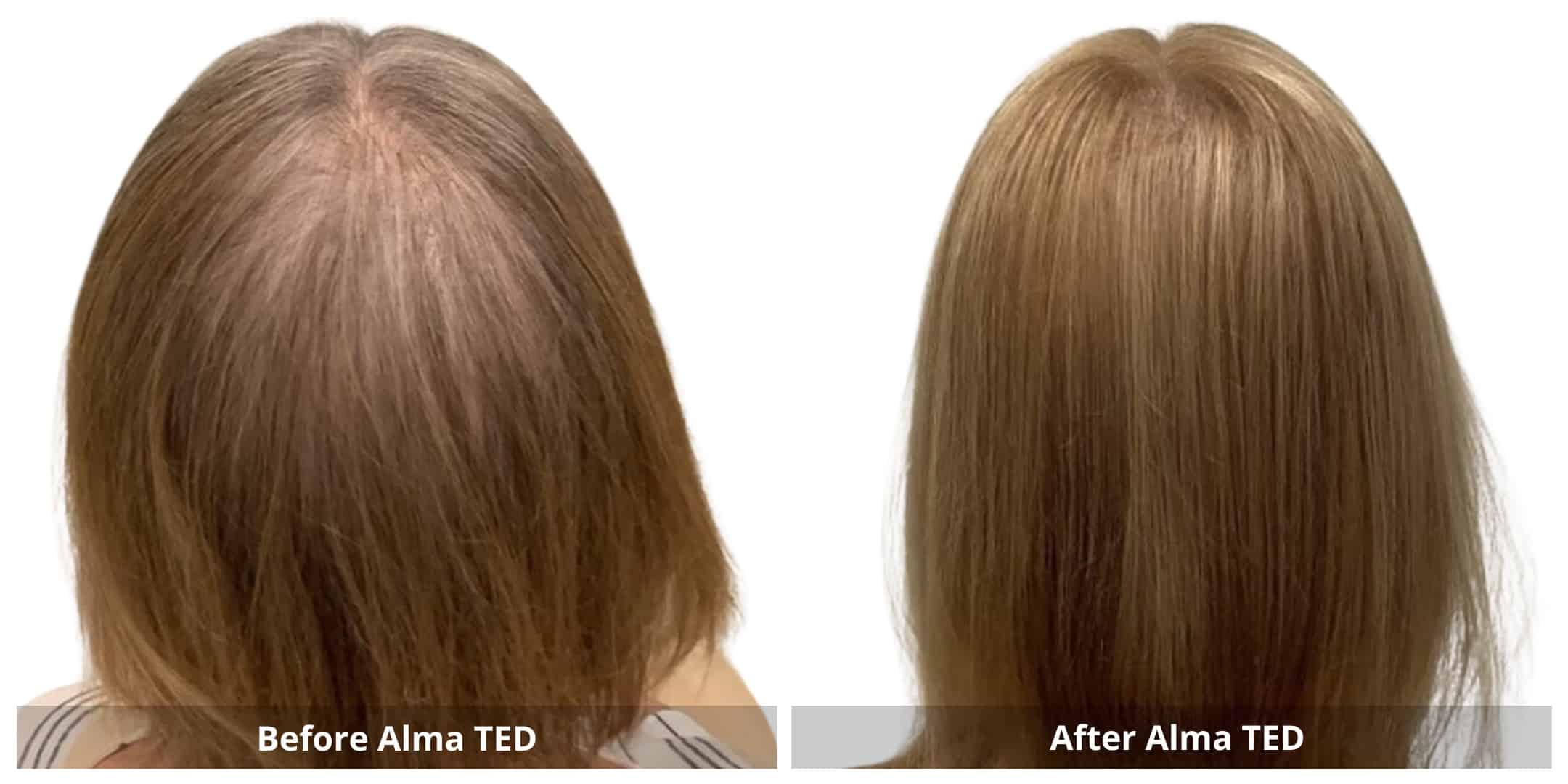 Alma ted hair restoration before and after photo 2