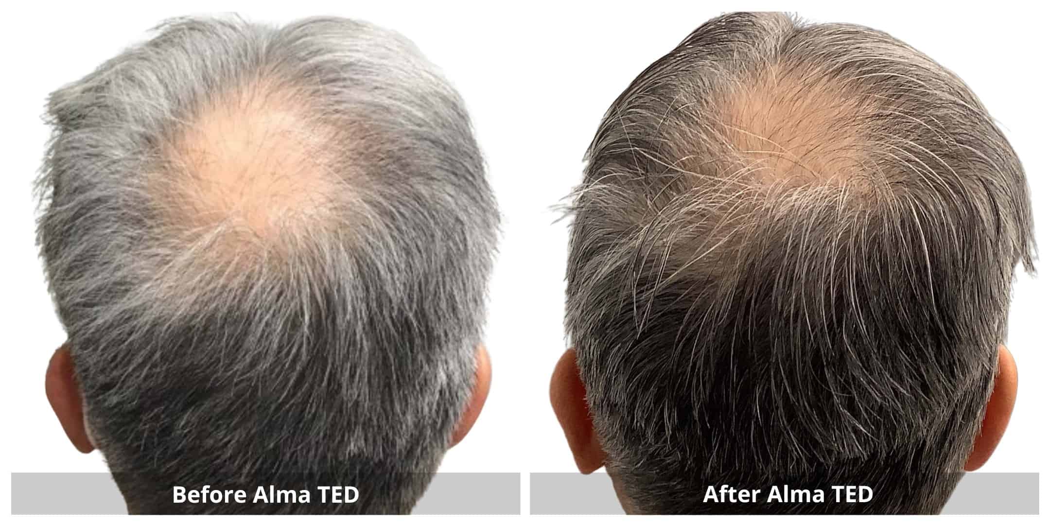 Alma ted hair restoration before and after photo 3