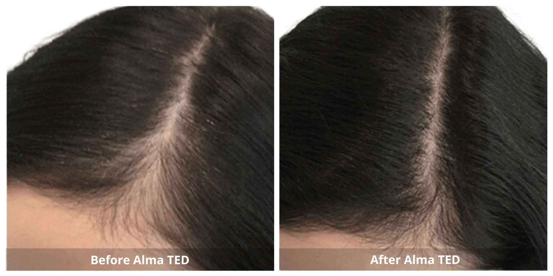 Alma ted hair restoration before and after photo 4