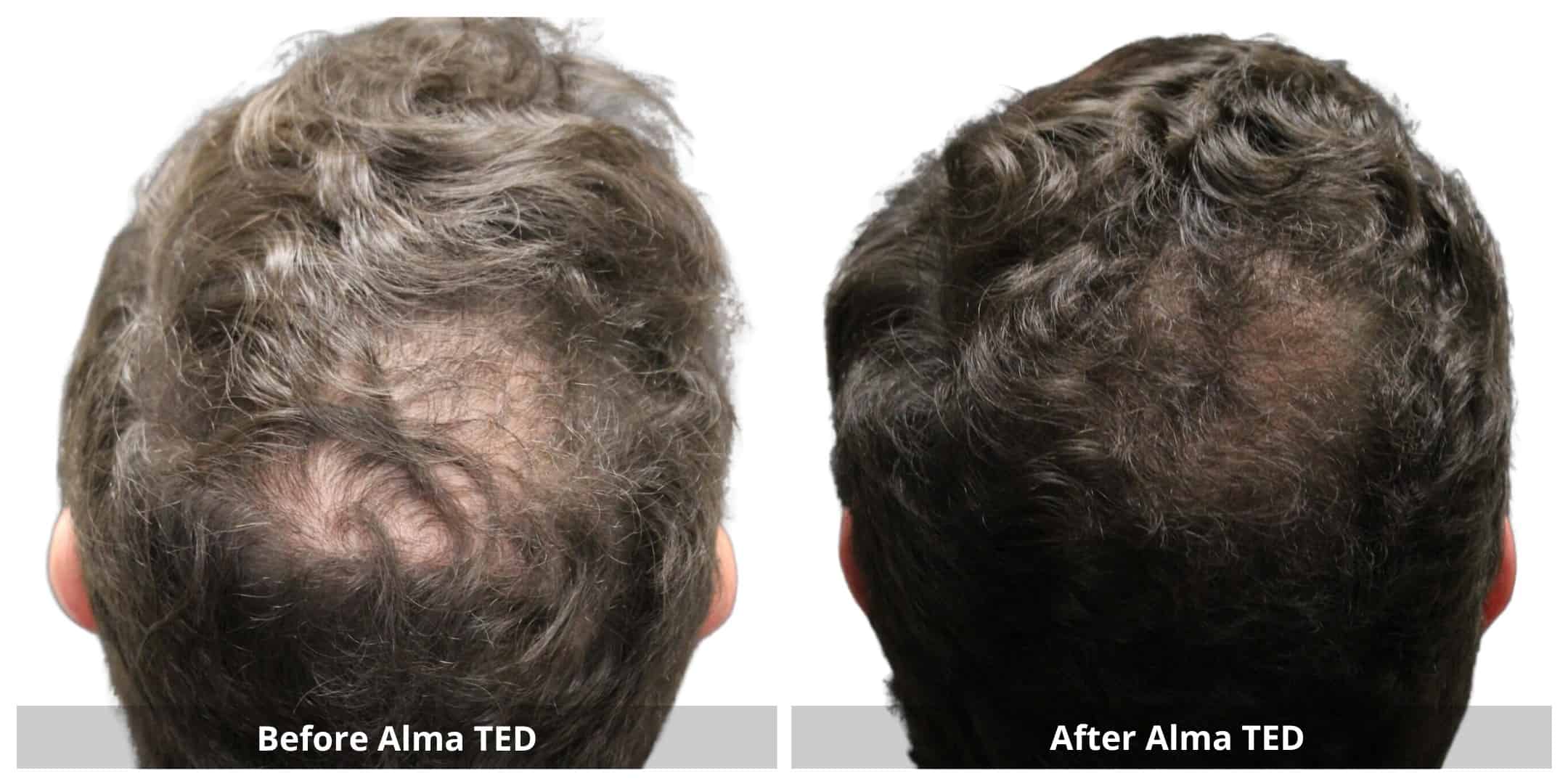 Alma ted hair restoration before and after photo 5