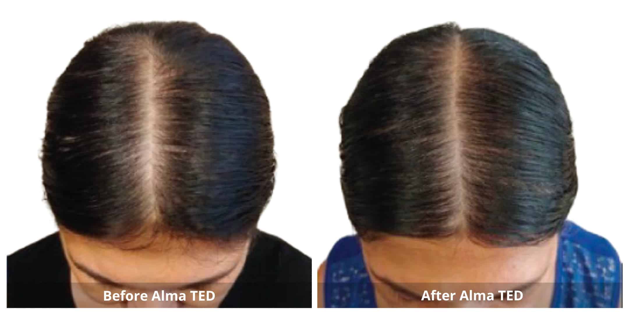 Alma ted hair restoration before and after photo 6