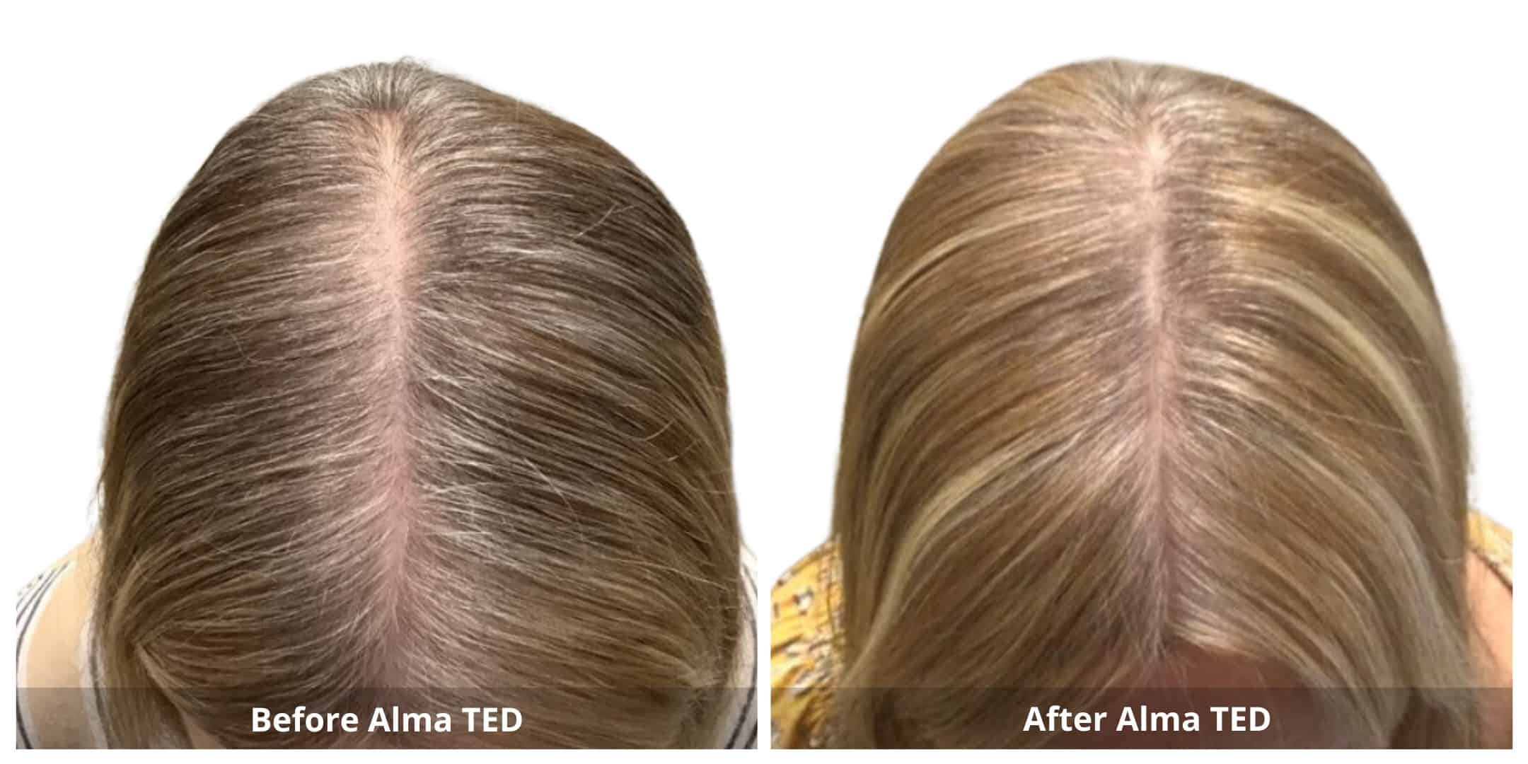 before and after the treatment of alma ted