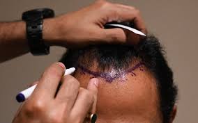 Hair Restoration in Waterloo: Your Guide to Regaining Confidence | Waterloo, ON | Sunshine Cosmetic Clinic & Medi Spa