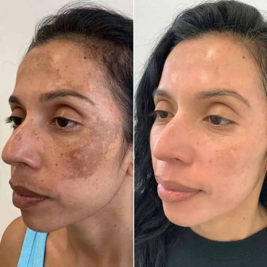 cosmelan-and-dermamelan-before-after-two
