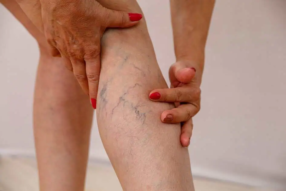 Spider Veins in Waterloo by Kitchener Waterloo MedSpa