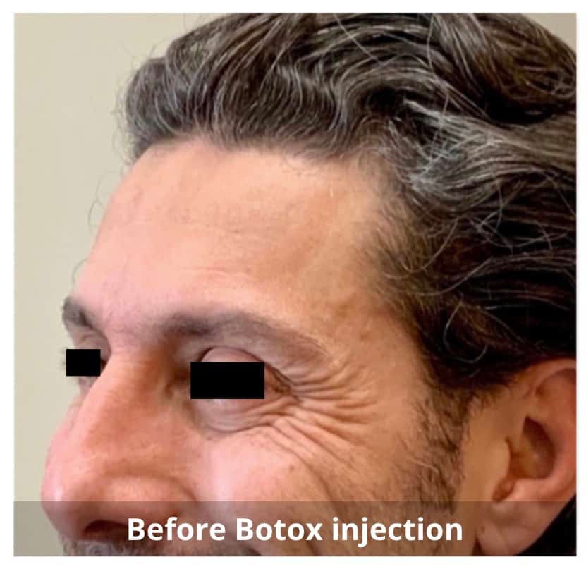 Botox Injections Waterloo & Kitchener