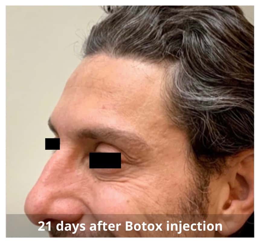 Botox Injections Waterloo & Kitchener