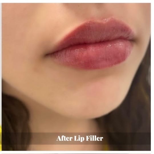 lip-filler-before-and-after-sunshine-kitchener-waterloo-medi-spa-1 - 1