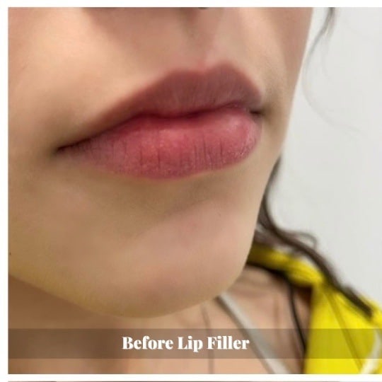 lip-filler-before-and-after-sunshine-kitchener-waterloo-medi-spa-1 – 1 lip-filler-before-and-after-sunshine-kitchener-waterloo-medi-spa-1 - 1