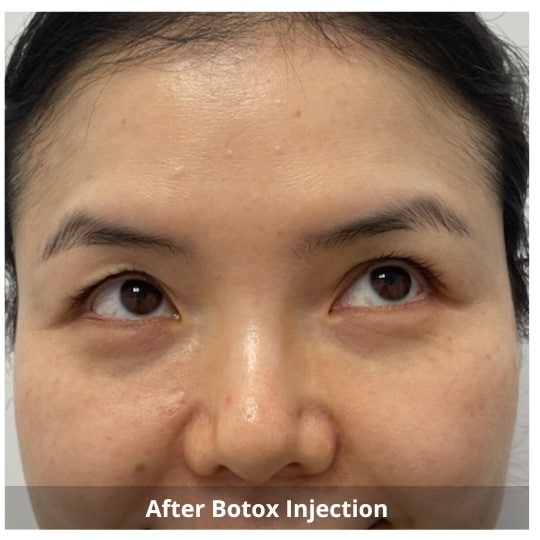 Botox Injections Waterloo & Kitchener