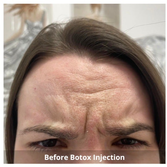 Botox Injections Waterloo & Kitchener