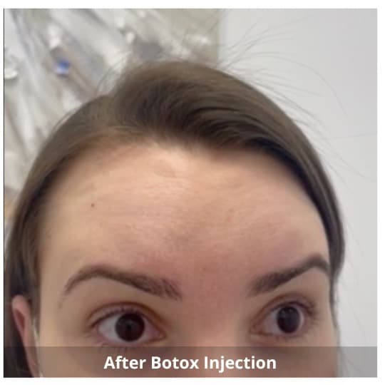 Botox Injections Waterloo & Kitchener