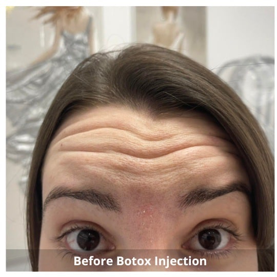 Botox Injections Waterloo & Kitchener