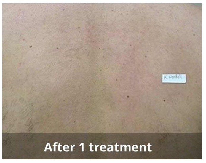 Before TempSure Before TempSure
