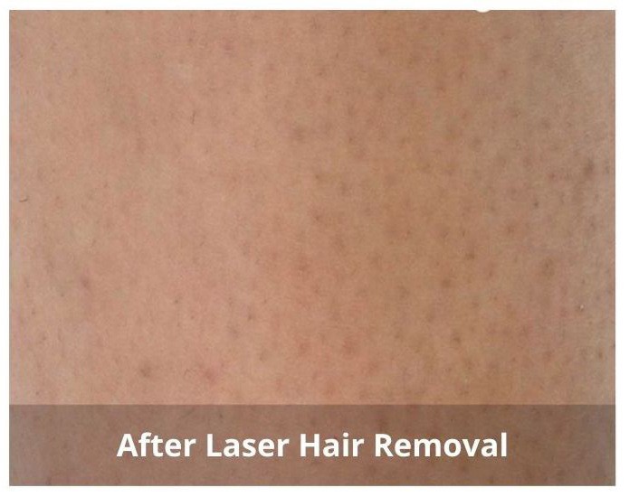 Before TempSure Before TempSure