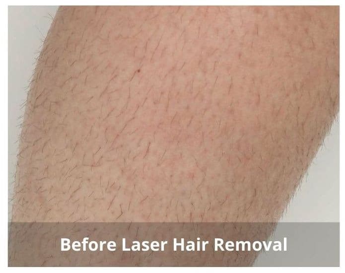 Before TempSure Before TempSure