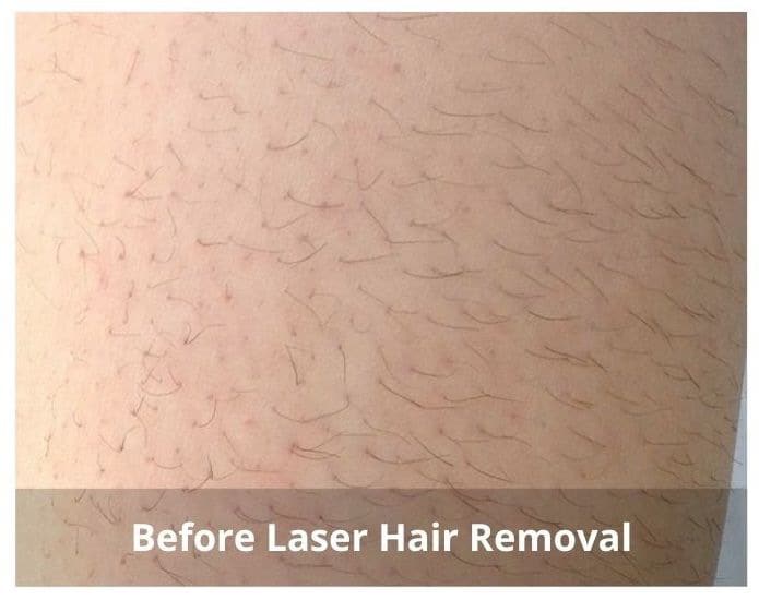 Before TempSure Before TempSure