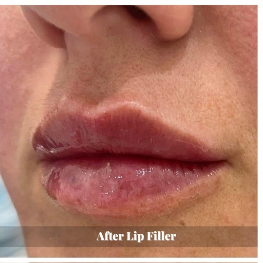 lip-filler-before-and-after-sunshine-kitchener-waterloo-medi-spa-A-one lip-filler-before-and-after-sunshine-kitchener-waterloo-medi-spa-A-one