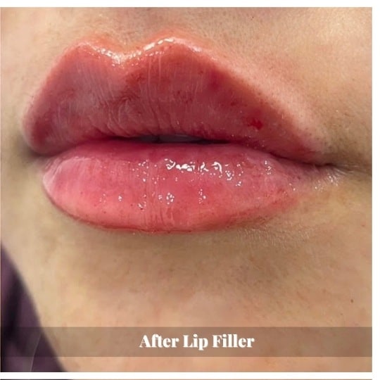 lip-filler-before-and-after-sunshine-kitchener-waterloo-medi-spa-A-three lip-filler-before-and-after-sunshine-kitchener-waterloo-medi-spa-A-three
