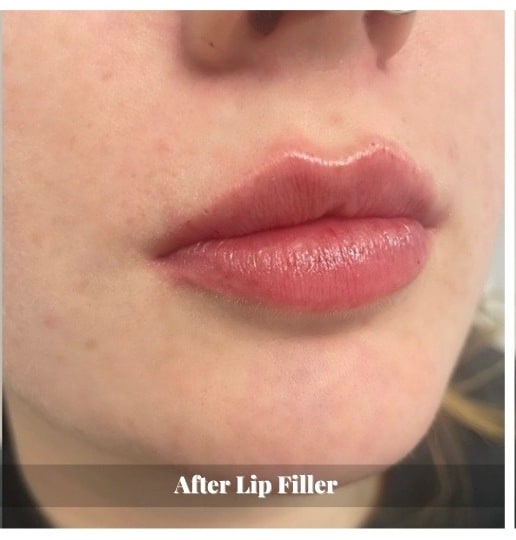 lip-filler-before-and-after-sunshine-kitchener-waterloo-medi-spa-A-two lip-filler-before-and-after-sunshine-kitchener-waterloo-medi-spa-A-two