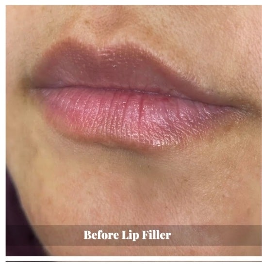 lip-filler-before-and-after-sunshine-kitchener-waterloo-medi-spa-B-three lip-filler-before-and-after-sunshine-kitchener-waterloo-medi-spa-B-three