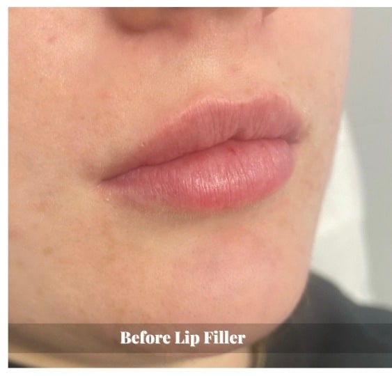 lip-filler-before-and-after-sunshine-kitchener-waterloo-medi-spa-B-two lip-filler-before-and-after-sunshine-kitchener-waterloo-medi-spa-B-two