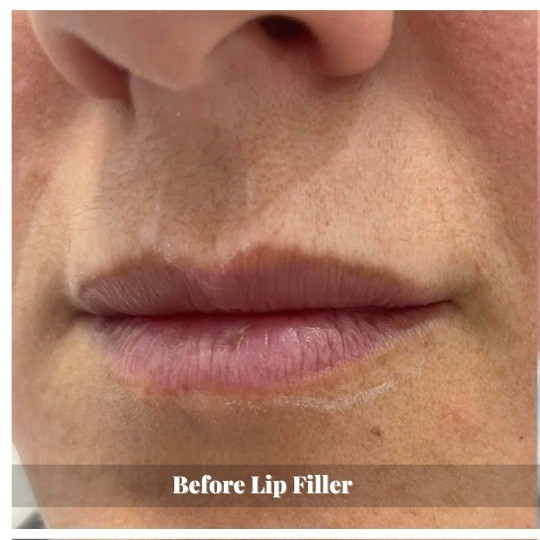 lip-filler-before-and-after-sunshine-kitchener-waterloo-medi-spa-b-one lip-filler-before-and-after-sunshine-kitchener-waterloo-medi-spa-b-one