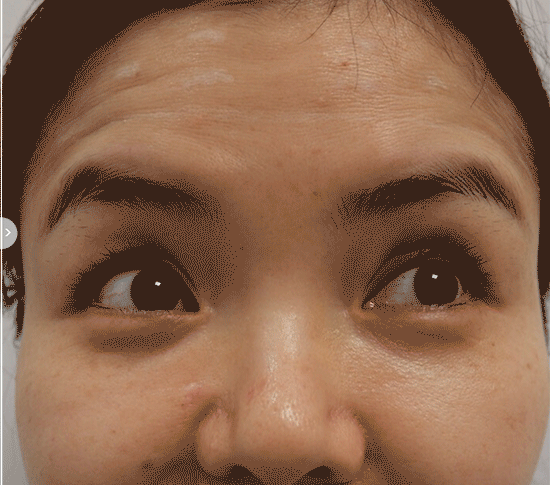 Botox for Forehead & Frown Lines
