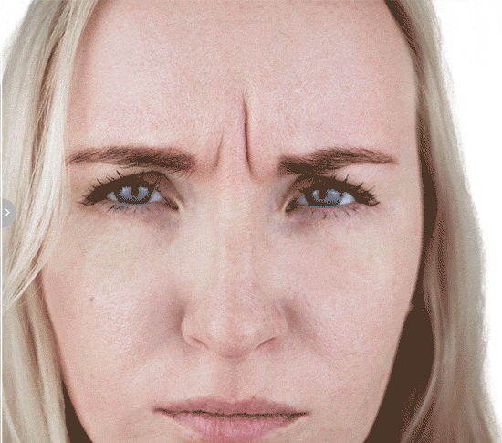 Botox for Forehead & Frown Lines