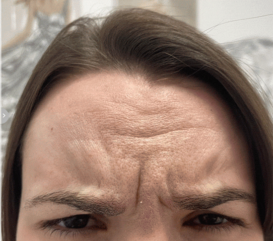 SUNSHINE COSMETIC CLINIC & MEDI SPA Botox for Forehead & Frown Lines