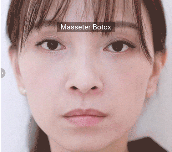 Test Page Botox (1)
