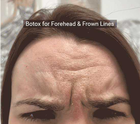 Test Page Botox (2)